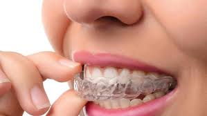 Clear Aligners